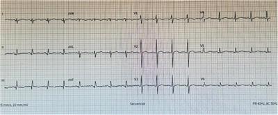 Case Report: Spontaneous acute hemopericardium